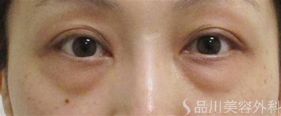 症例NO.55779のBEFORE写真