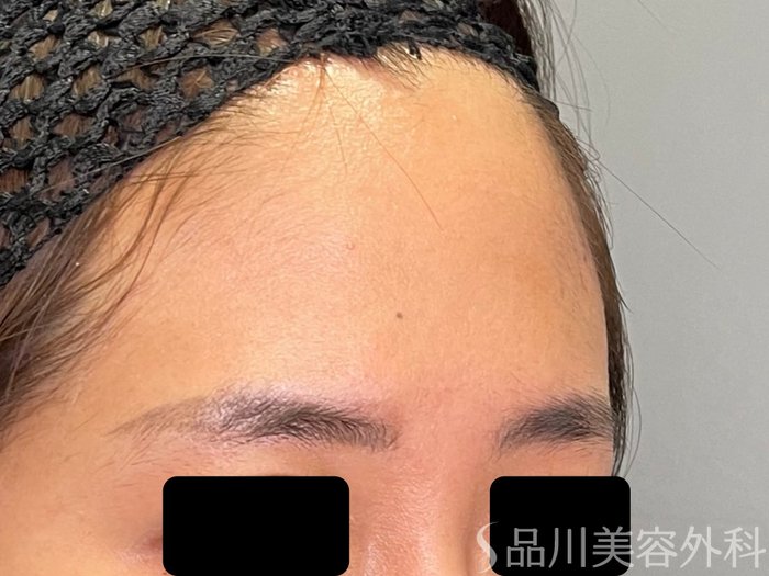 症例NO.70592のBEFORE写真