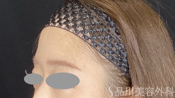 症例NO.69578のBEFORE写真