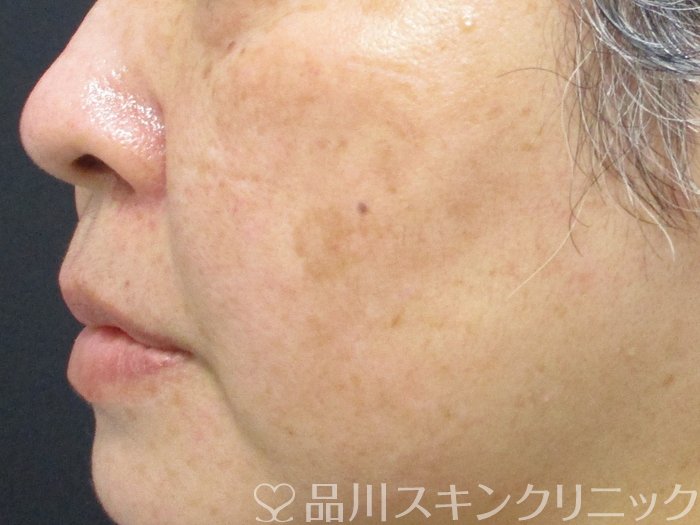 症例NO.65382のBEFORE写真