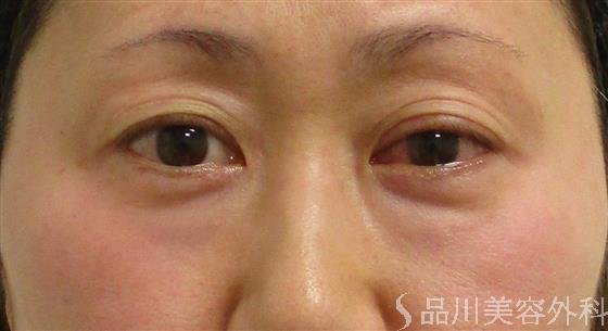 症例NO.60184のBEFORE写真