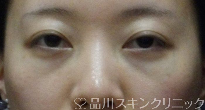 症例NO.68628のAFTER写真