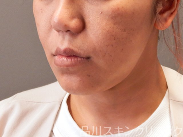 症例NO.70984のAFTER写真