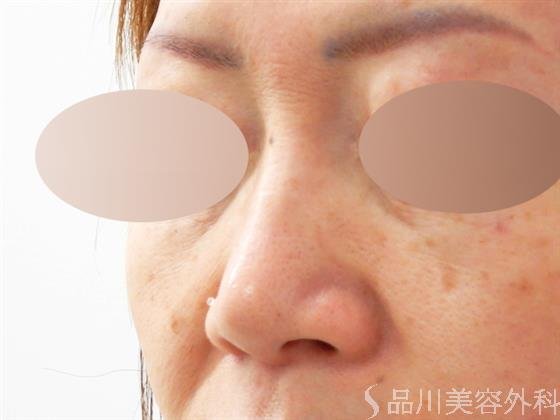 症例NO.54479のBEFORE写真