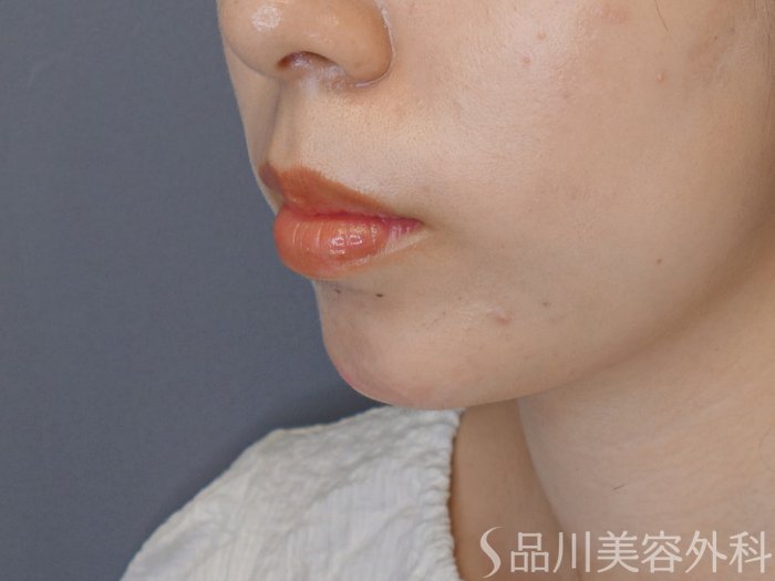 症例NO.70681のAFTER写真