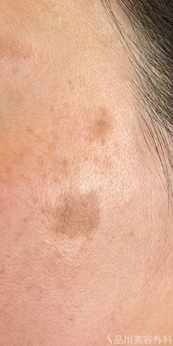 症例NO.72476のBEFORE写真