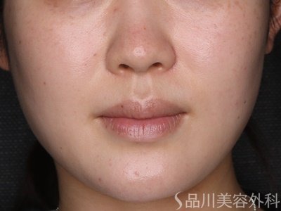 症例NO.74134のBEFORE写真
