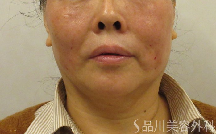 症例NO.73082のAFTER写真