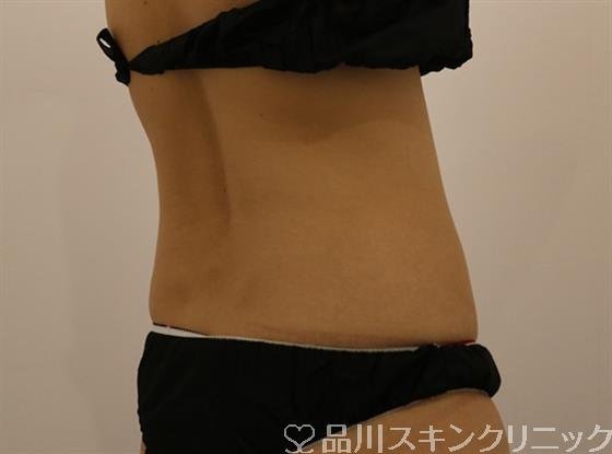症例NO.43724のAFTER写真