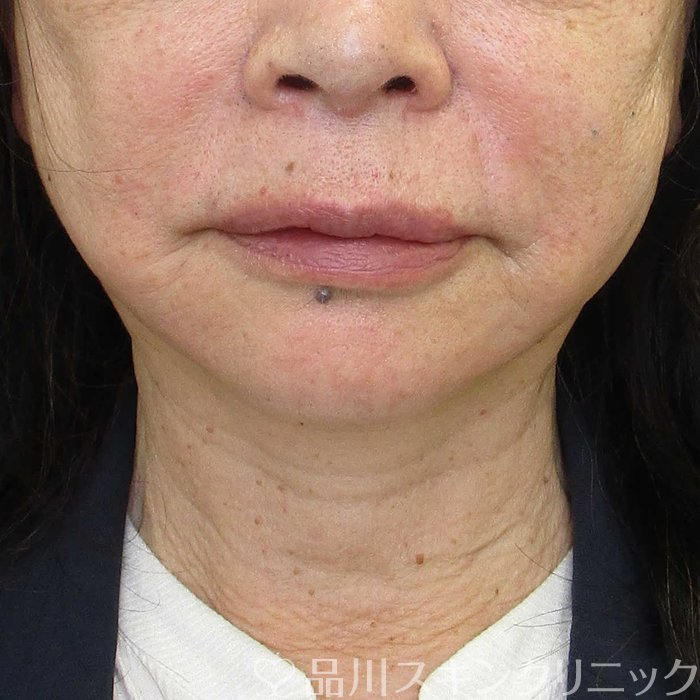 症例NO.65549のAFTER写真