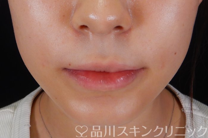 症例NO.66676のAFTER写真
