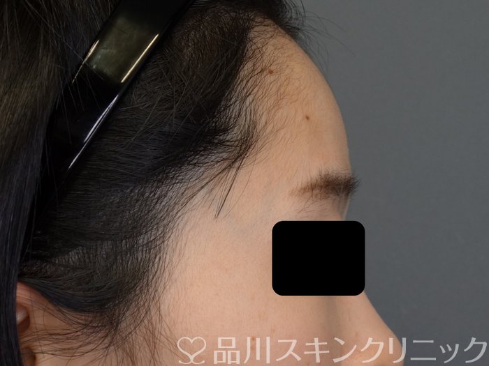 症例NO.74090のBEFORE写真