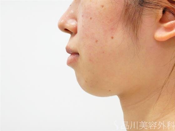 症例NO.53523のBEFORE写真