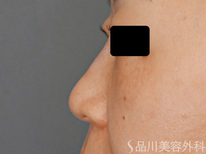 症例NO.63319のAFTER写真