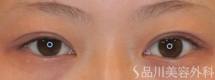 症例NO.64461のAFTER写真