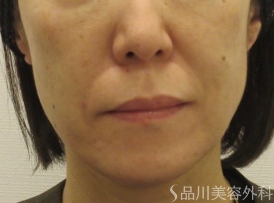 症例NO.75171のBEFORE写真