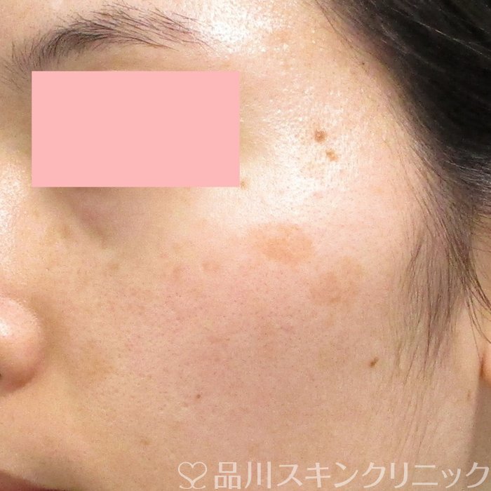 症例NO.71923のBEFORE写真