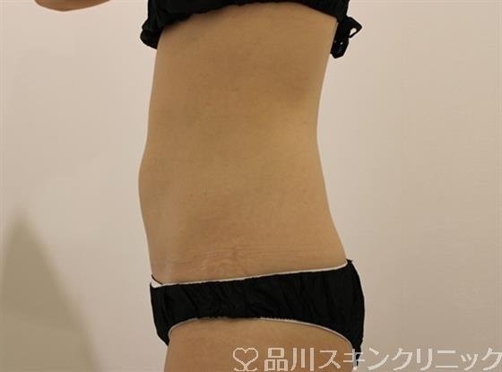 症例NO.44531のAFTER写真