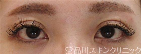 症例NO.41815のAFTER写真