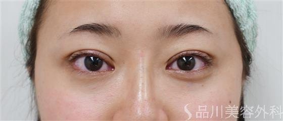 症例NO.37382のBEFORE写真