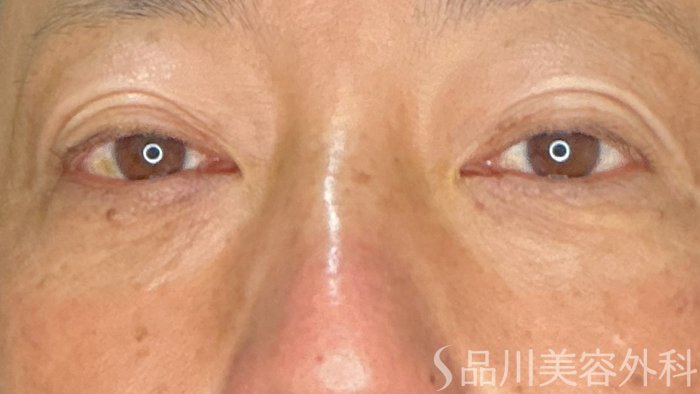 症例NO.71845のAFTER写真