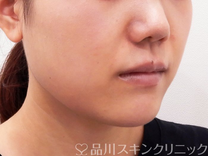 症例NO.63696のBEFORE写真