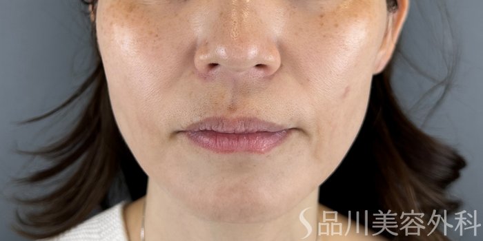 症例NO.70175のBEFORE写真
