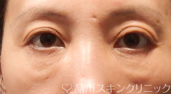 症例NO.70660のBEFORE写真