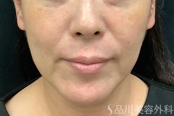 症例NO.69706のBEFORE写真
