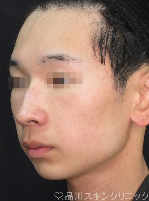 症例NO.73057のAFTER写真