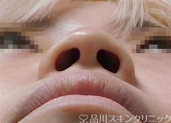 症例NO.56430のBEFORE写真
