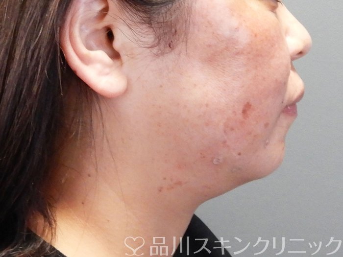 症例NO.69191のAFTER写真