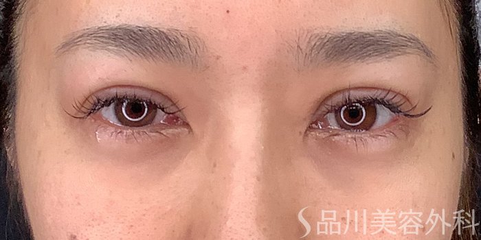 症例NO.71238のAFTER写真