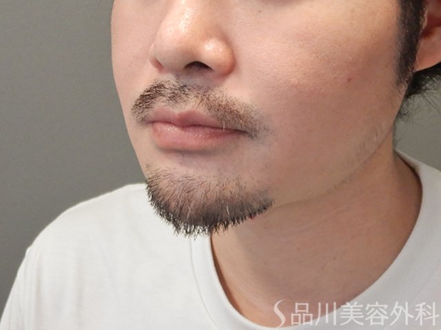 症例NO.74957のAFTER写真