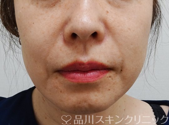 症例NO.67469のBEFORE写真