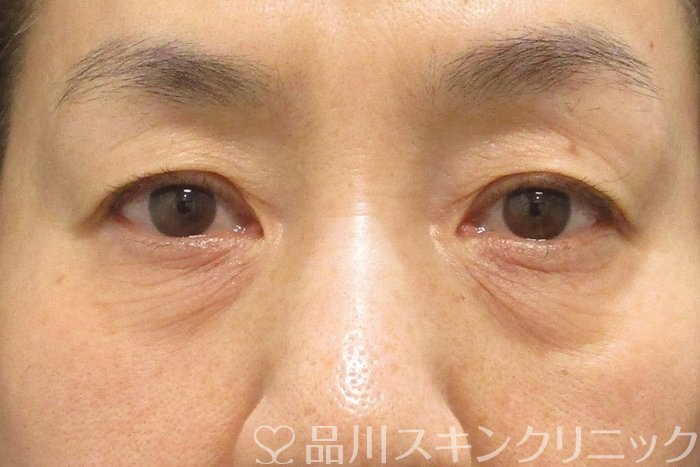 症例NO.70148のBEFORE写真