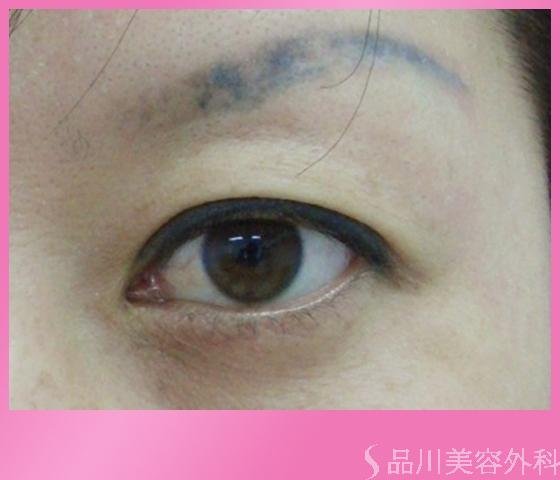 症例NO.1154のBEFORE写真