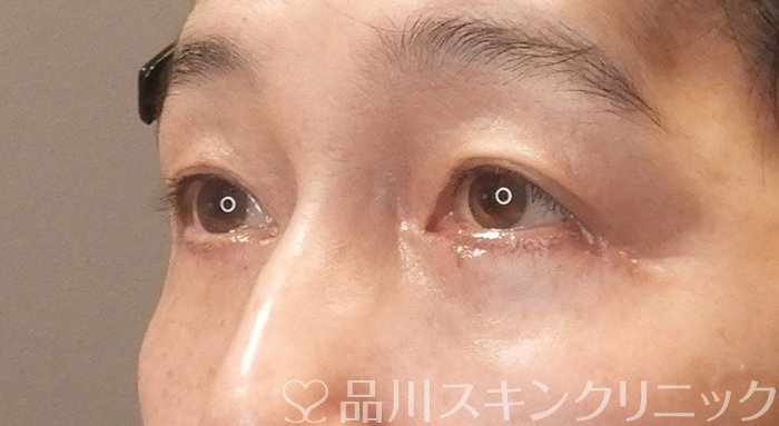 症例NO.63445のAFTER写真