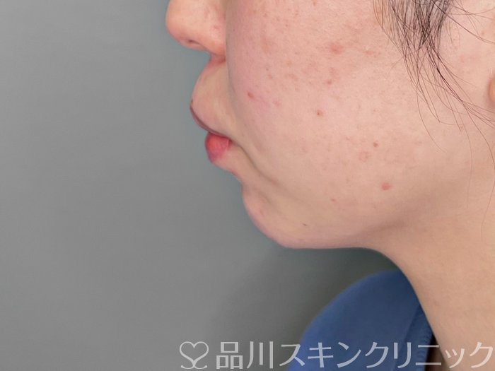 症例NO.70052のBEFORE写真