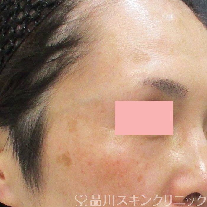 症例NO.72125のBEFORE写真