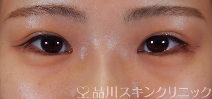 症例NO.66516のAFTER写真