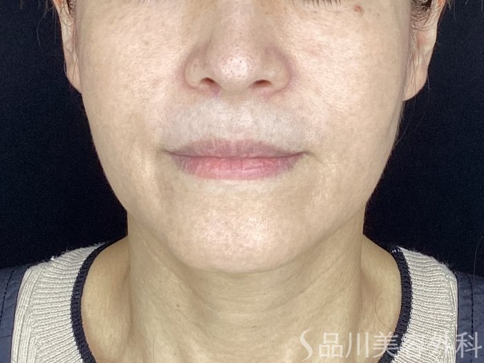 症例NO.67605のBEFORE写真