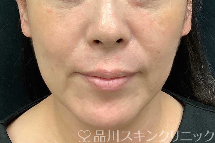 症例NO.69706のBEFORE写真