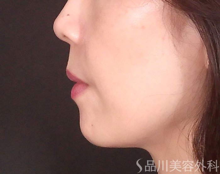 症例NO.71393のBEFORE写真