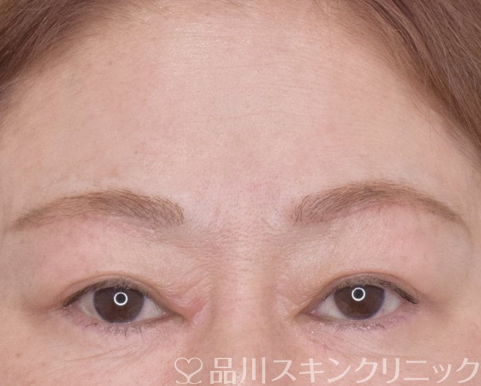 症例NO.65420のAFTER写真