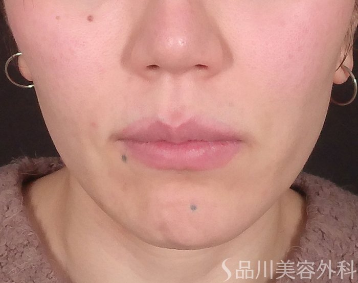 症例NO.69632のBEFORE写真