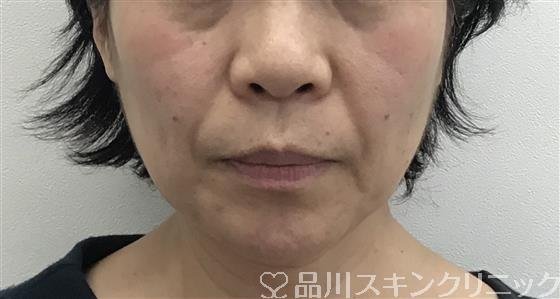 症例NO.47013のBEFORE写真