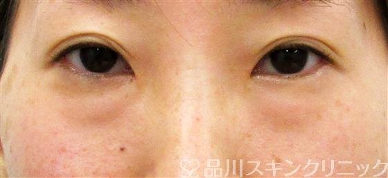症例NO.44382のBEFORE写真