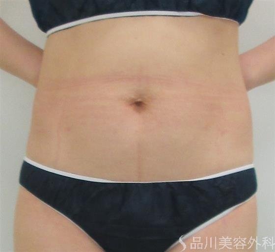 症例NO.23444のAFTER写真