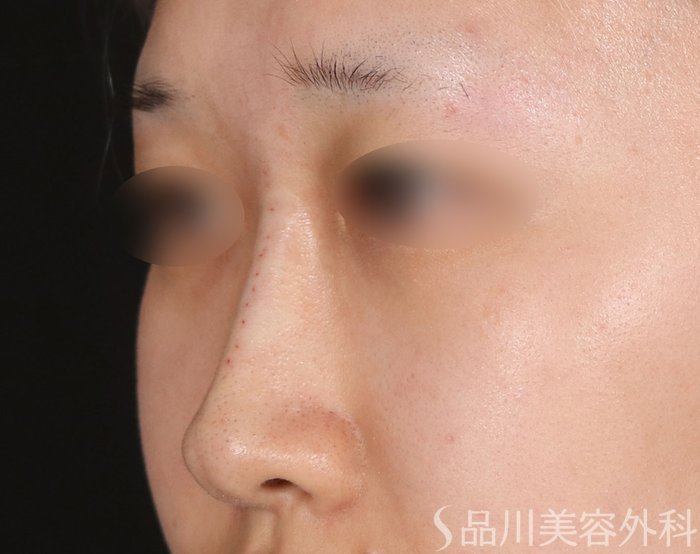 症例NO.73226のAFTER写真